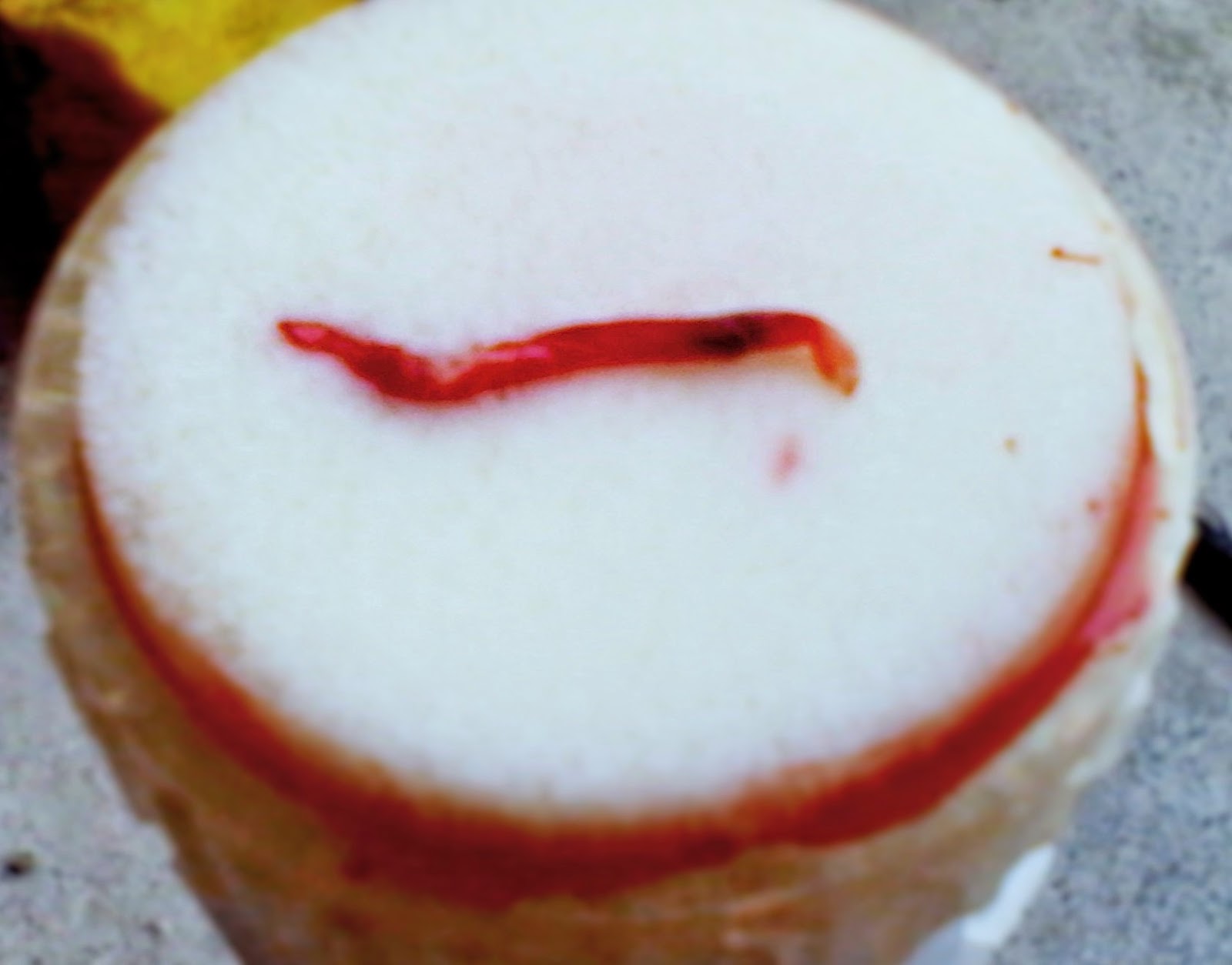 Dialysis Day Heamodialysis Risk Catheter (permacath) & Blood Clot