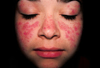 SYSTEMIC LUPUS ERYTHEMATOSUS SYSTEMIC LUPUS ERYTHEMATOSUS
