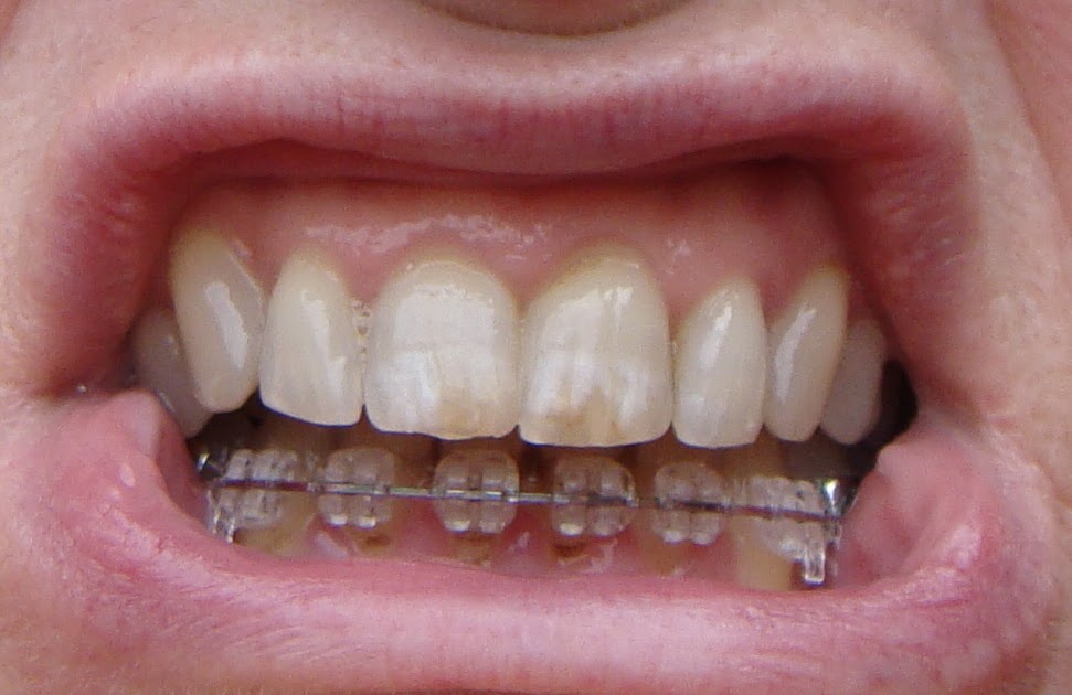Braces at 56 Last adjustment! Incognito and Inspire Ice braces off at
