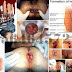 Obat Anus Susah Berak atau Buang Air Besar thumbnail
