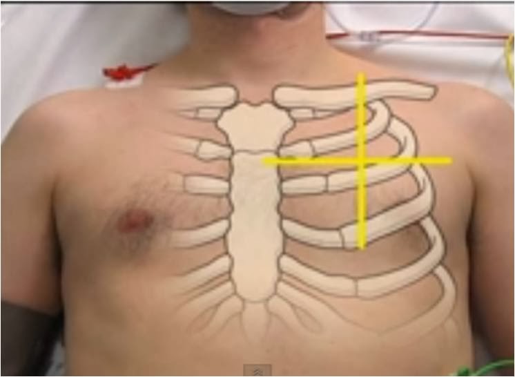 Phimaimedicine 2,631 Needle aspiration of primary spontaneous pneumothorax