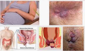 Obat Wasir Fructus Sophorae Obat Wasir Fructus Sophorae