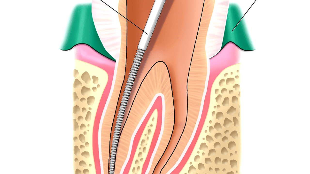 Gutta Percha Root Canal Dangers Danger Choices