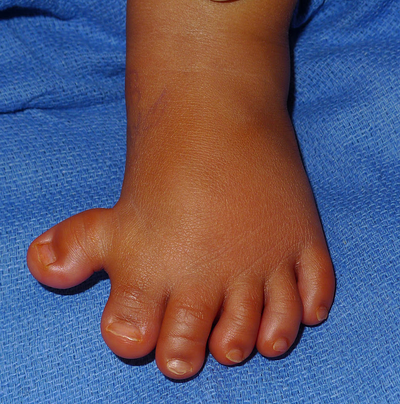 Toe Polydactyly Congenital Hand and Arm Differences Washington