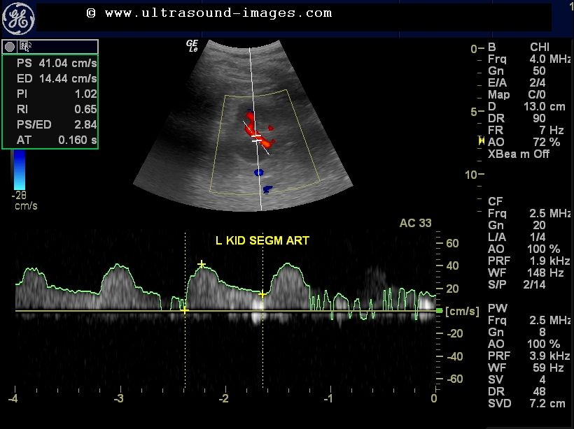 renal artery doppler ultrasound renal artery doppler ultrasound