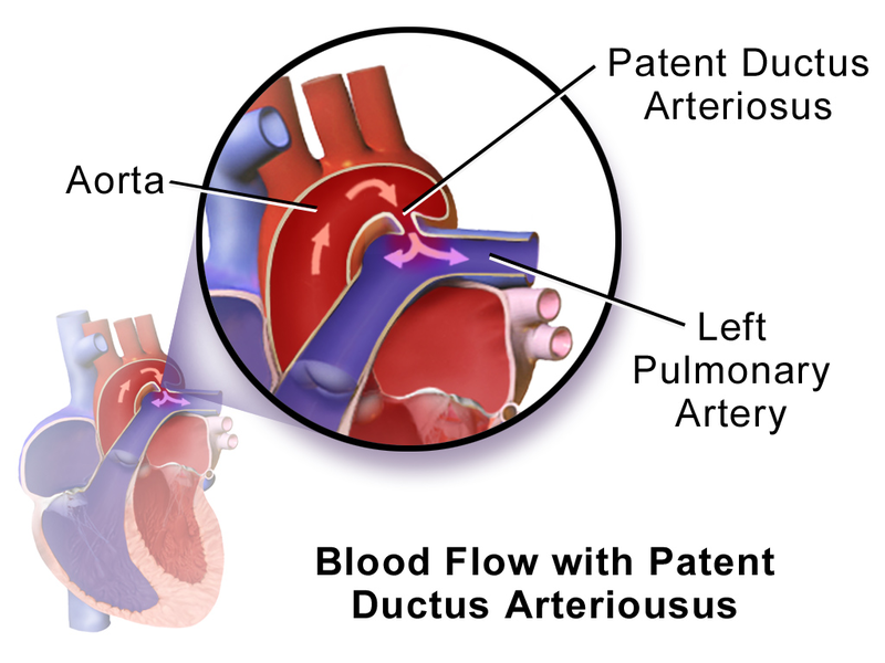 Patent ductus arteriosus PDA Cardiovascular Nurse