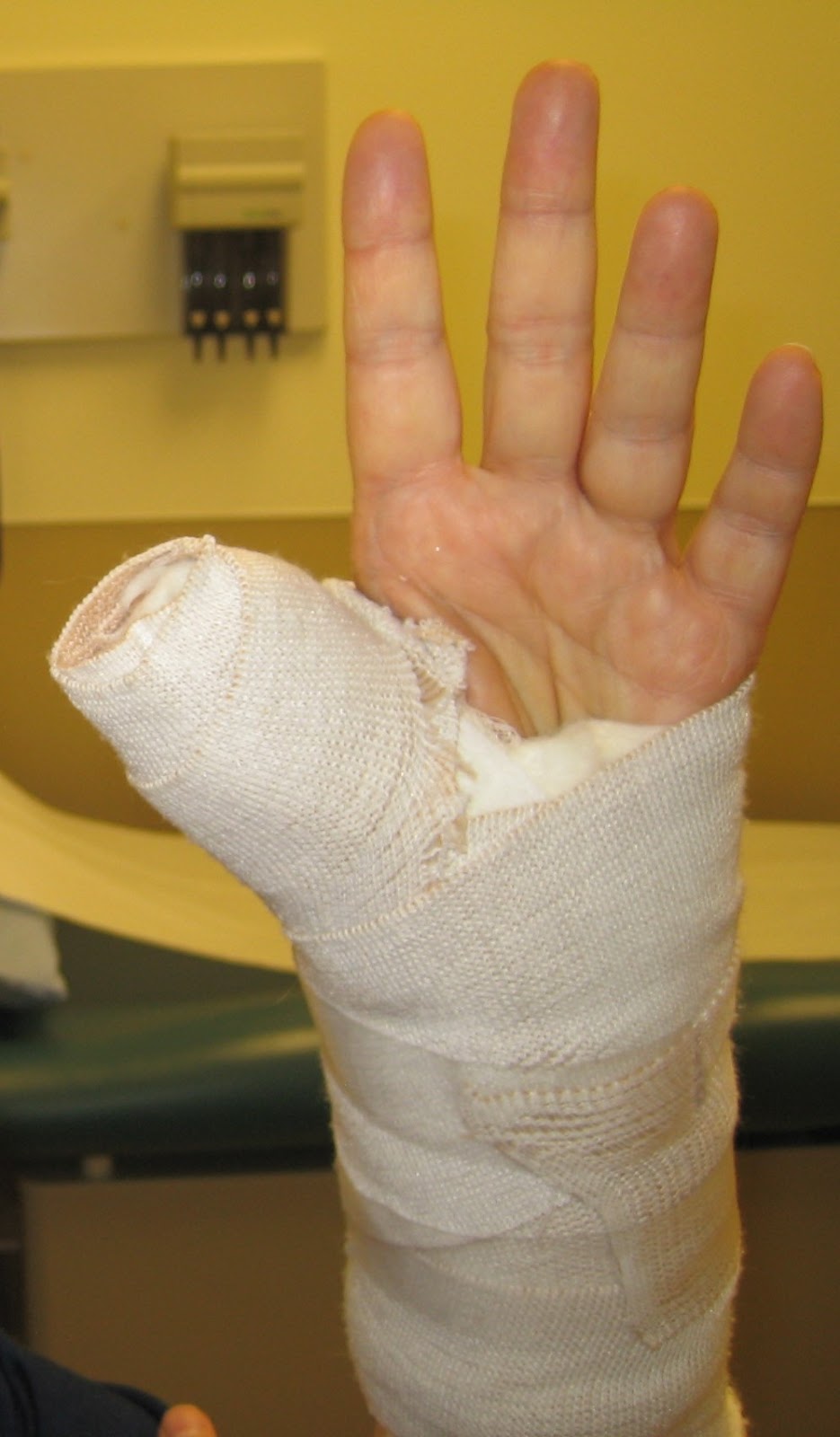 Quilting Momma & The Youngest 11 days post surgery Basal thumb arthroplasty with tendon