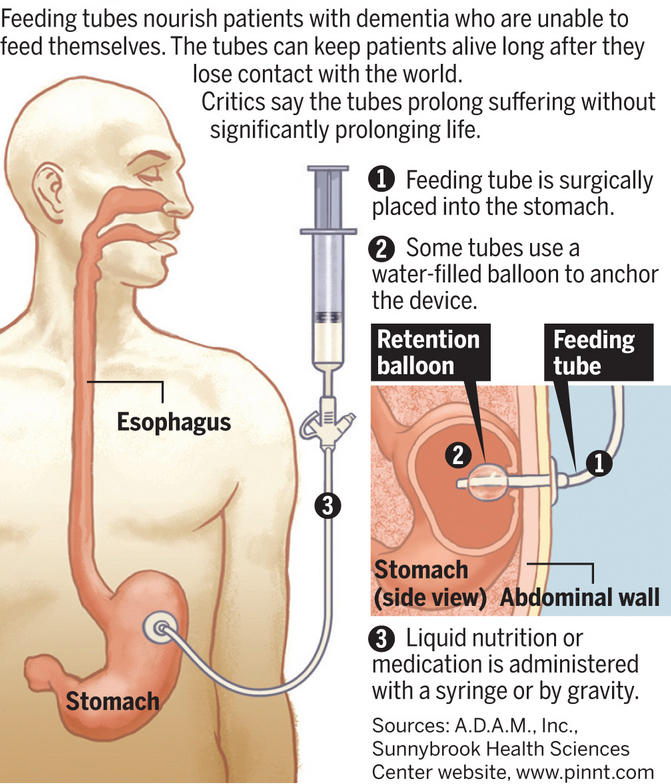Insertion and management of nasogastric tubes for adults