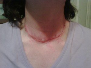 10 000 strong against thyroid cancer you need a thyroidectomy now