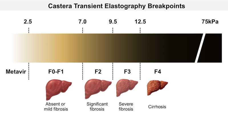 Liver Fibroscan Score Chart