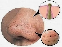 COMO ACABAR COM OS CRAVOS DO ROSTO E NARIZ COM CANELA E MEL - RECEITA CASEIRA NATURAL COMO ACABAR COM OS CRAVOS DO ROSTO E NARIZ COM CANELA E MEL - RECEITA CASEIRA NATURAL