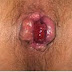 Gejala Ambeien thumbnail