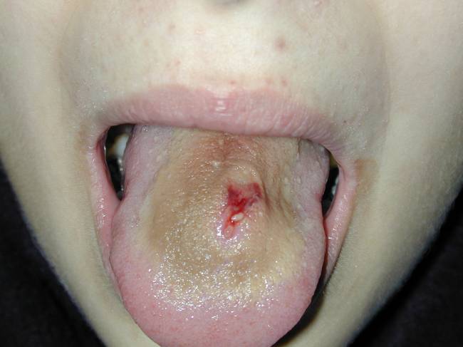 danger tongue piercing
