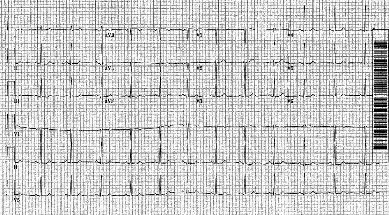 EKG Challenge No. 12 Case Conclusion: Because We’re Only Human – FOAM