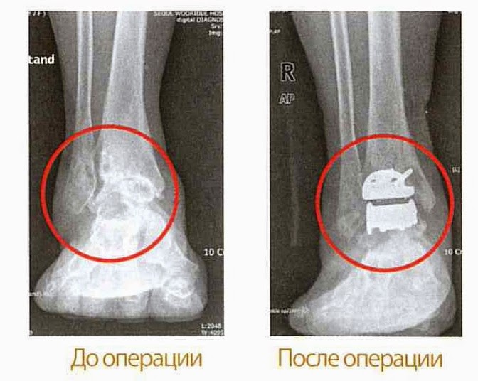 Ревматоидный артрит лечение в пятигорске Ревматоидный артрит лечение в пятигорске