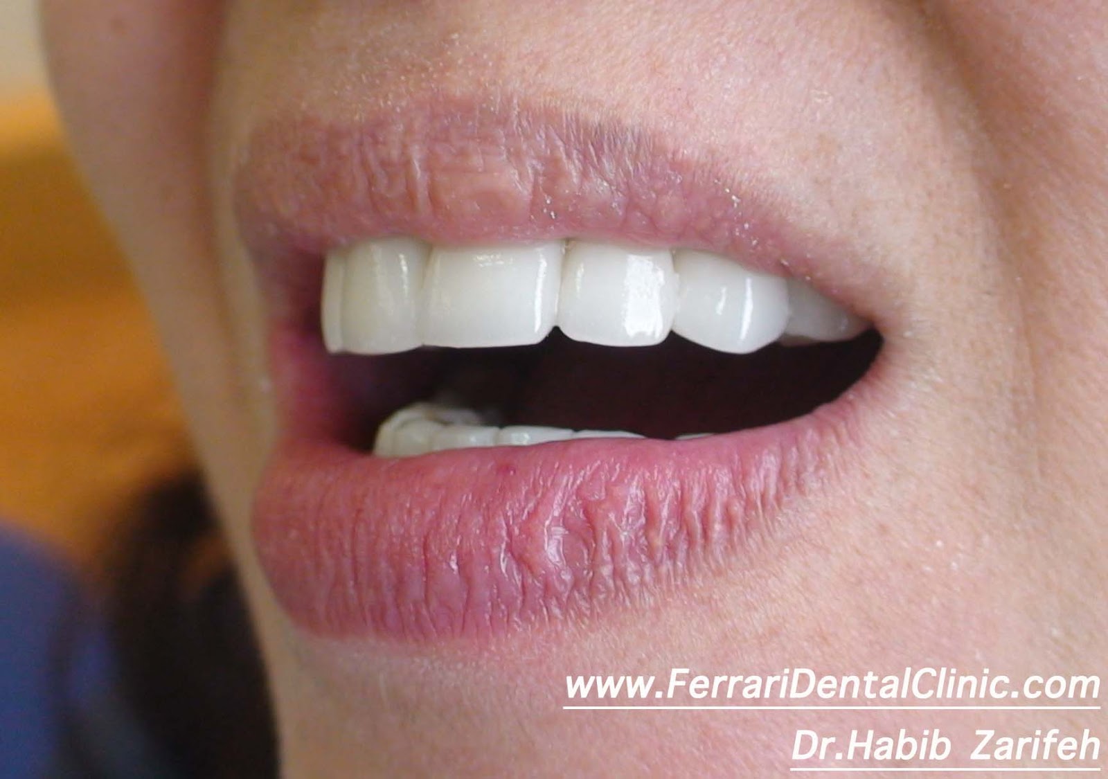 Dental implants Lebanon specialist Dr.Habib Zarifeh