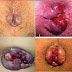 Obat Buat Wasir Parah thumbnail