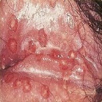 sipilis wanita sipilis wanita