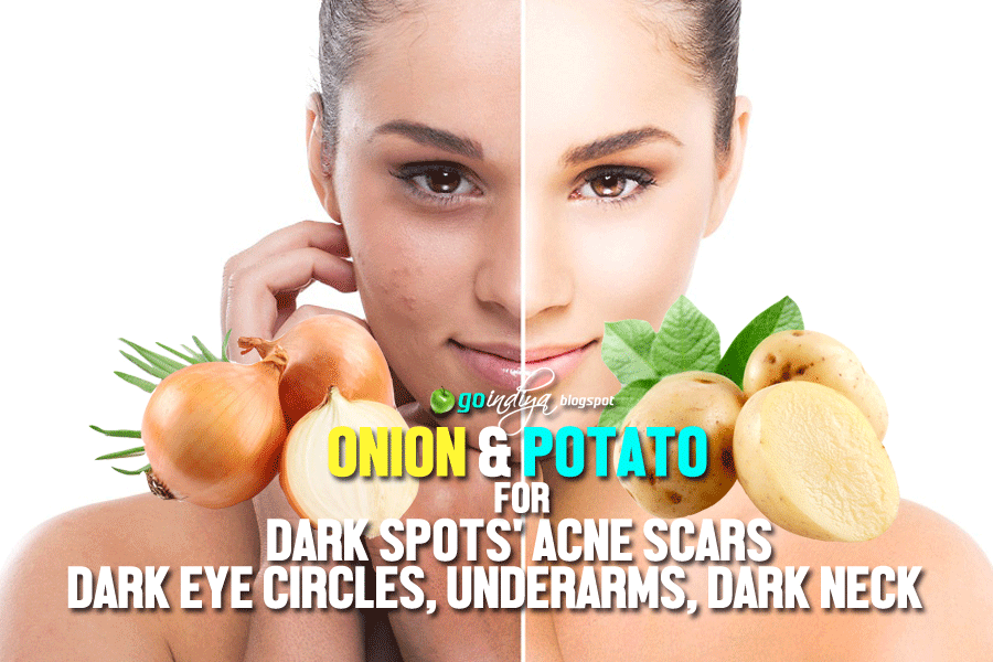 Onion & Potato for Dark Spots, Acne Scars, Dark Eye Circles, Underarms