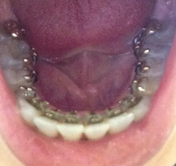 Lingual Brace Easter Braces