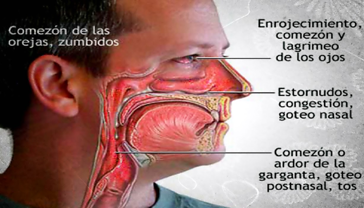 Síntomas de alergias respiratorias Síntomas de alergias respiratorias