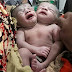 The baby with two heads: Bangladeshi mother gives birth to conjoined twins who share the same body and organs