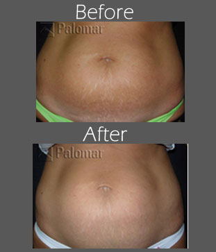 Tattoo Removal Before And After Tattoo Removal Before And After