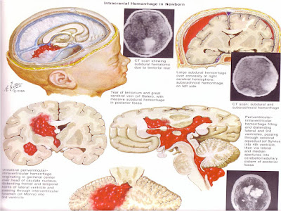 Penatalksanaan Fisioterapi Pada Cerebral Palsy