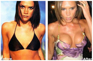 Victoria Beckham Breast Implants