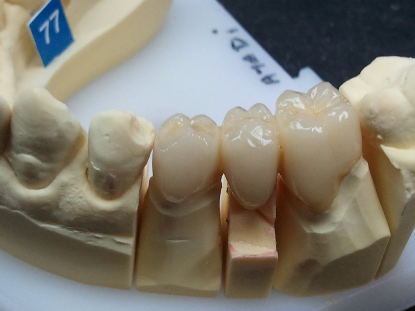 blog prothesiste dentaire Le laboratoire vient d'acquérir d'une fraiseuse dentaire roland dwx-51d une des plus sur le blog des prothésiste dentaire dans le site aller aux fraises. blog prothesiste dentaire Le laboratoire vient d'acquérir d'une fraiseuse dentaire roland dwx-51d une des plus sur le blog des prothésiste dentaire dans le site aller aux fraises.