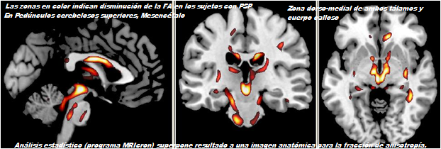 Neuroanatomía Dr William Ganem Parálisis Supranuclear Progresiva Síndrome De Steele Richardson Olszewski<script async src=