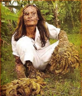 Aneka Misteri 14 Jenis Penyakit Aneh Dan Langka Di Dunia