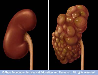 Kidney Disease