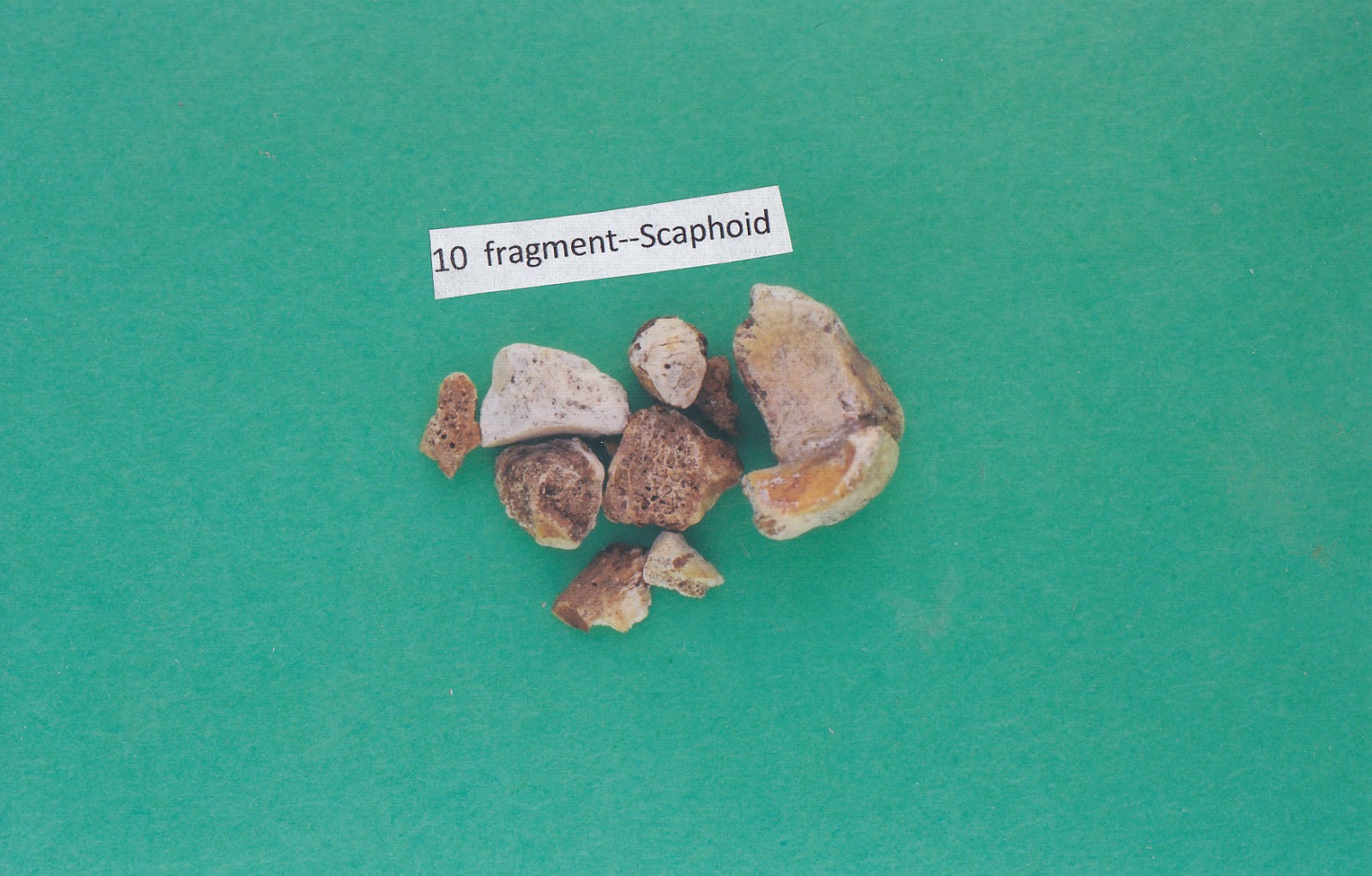 Scaphoid Bone Fracture Rays of this fracture rarely reveal how fragmented and serious it is -4.bp.blogspot.com