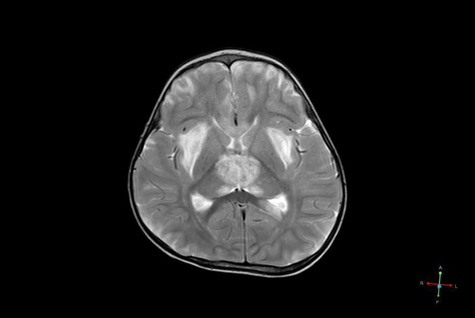 acute encephalopathy