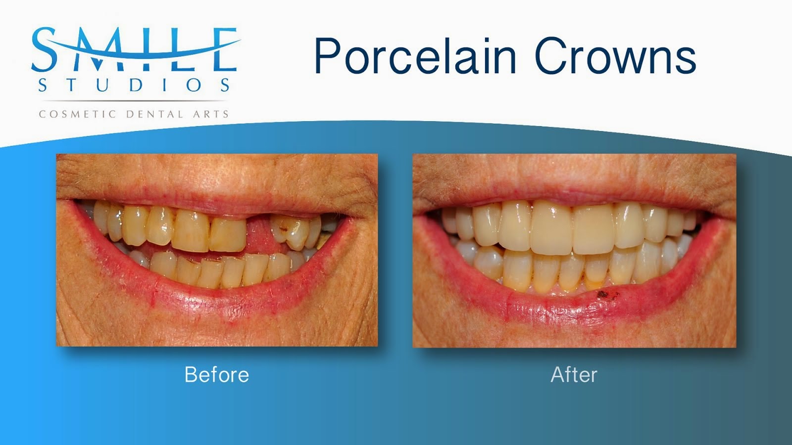 Porcelain Crowns