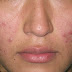 Acne cream De bella Sangat Cepat Mengecutkan Jerawat!