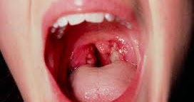 Tonsillitis pictures and symptoms image