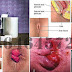 Obat Sakit AMBEIEN atau WASIR Paling AMPUH thumbnail