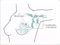 inflammatory breast cancer