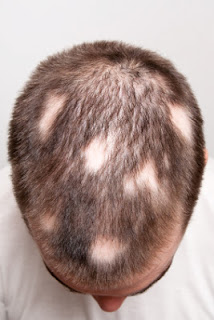 Steroid injection alopecia areata