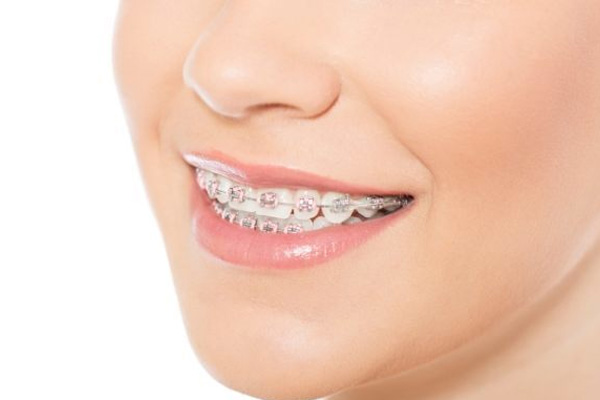 Orthodontist for metal braces in Heidelberg, Rosanna, Ivanhoe, Eaglemont & Macleod