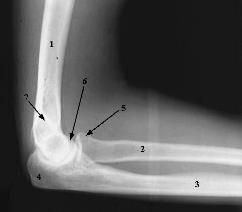 Shattered+Elbow+Recovery+Time Shattered Elbow Recovery Time http://www.thedamageisdone.net/2011/11/i ...