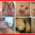 Obat Antivirus HPV Tradisional Kutil Kelamin thumbnail