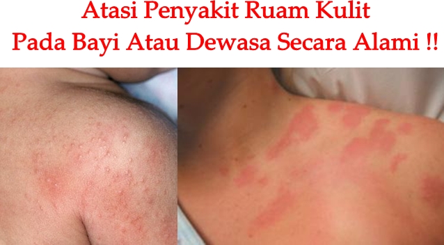 CaraMengobatiRuamKulitPadaBayiAtauDewasaCara CaraMengobatiRuamKulitPadaBayiAtauDewasaCara