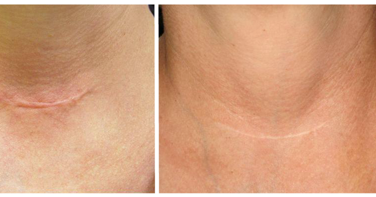 Laserderm: Scar Reduction Treatments