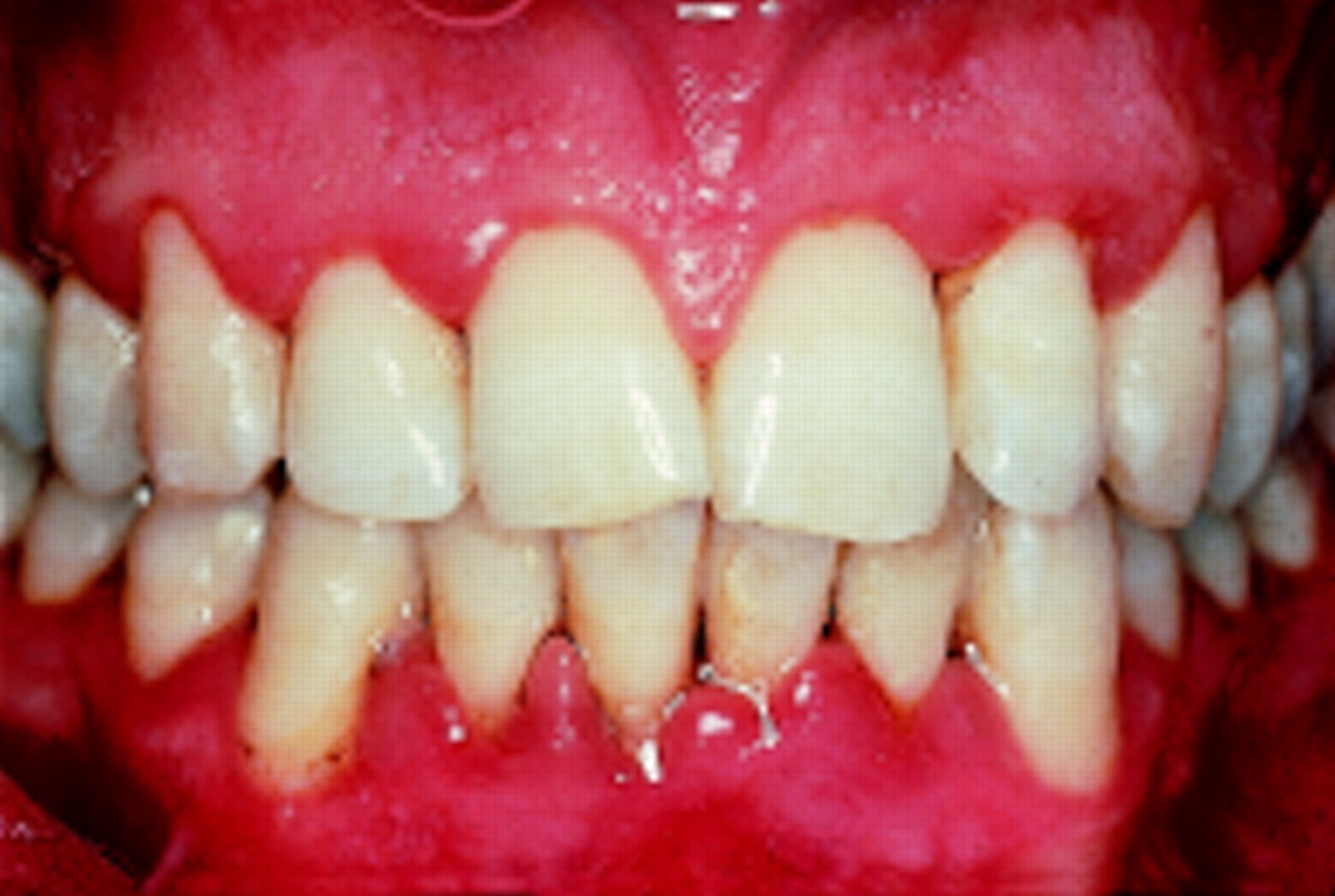Kesan pertama Gingivitis