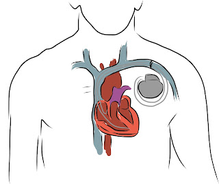 Cardiac Pacemaker Cardiac Pacemaker