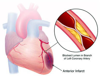 coronary heart disease conclusion