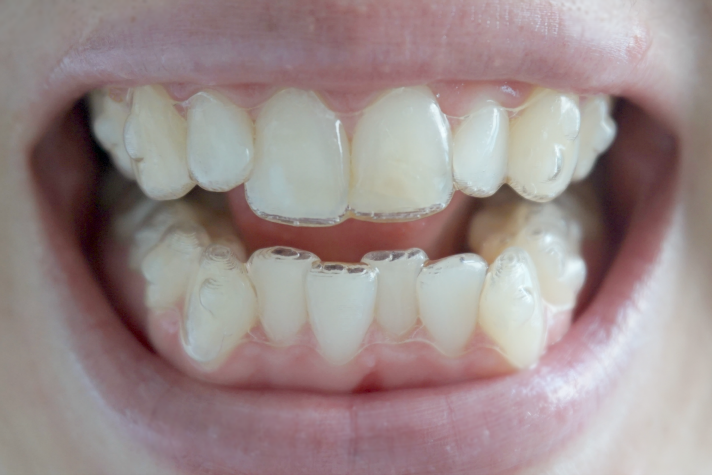 invisalign attachments